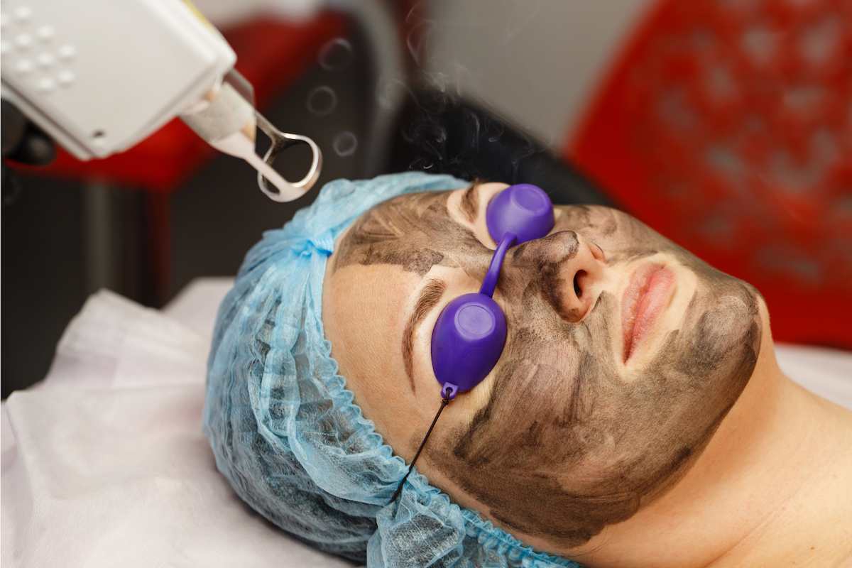 Tattoo Removal Carbon Facial