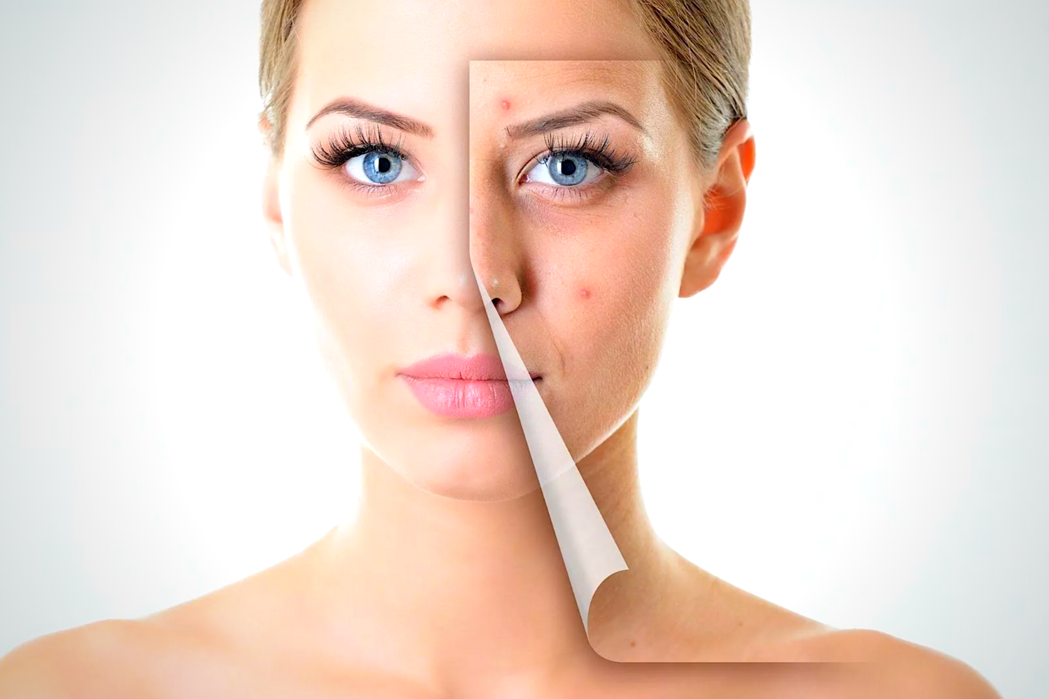 Acne Therapy